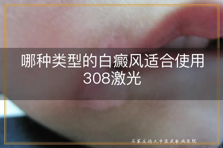 哪种类型的白癜风适合使用308激光