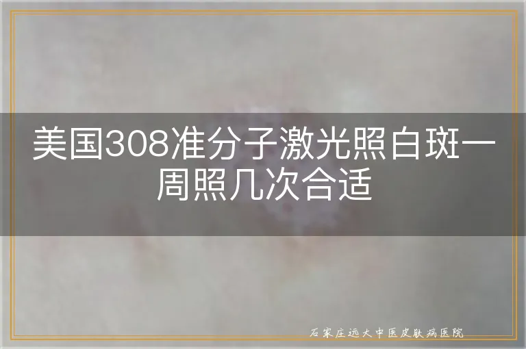 美国308准分子激光照白斑一周照几次合适