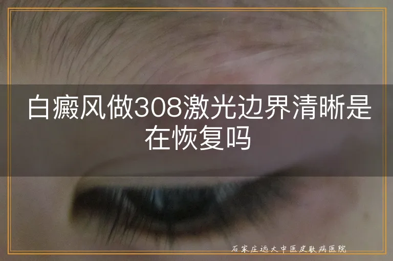 白癜风做308激光边界清晰是在恢复吗