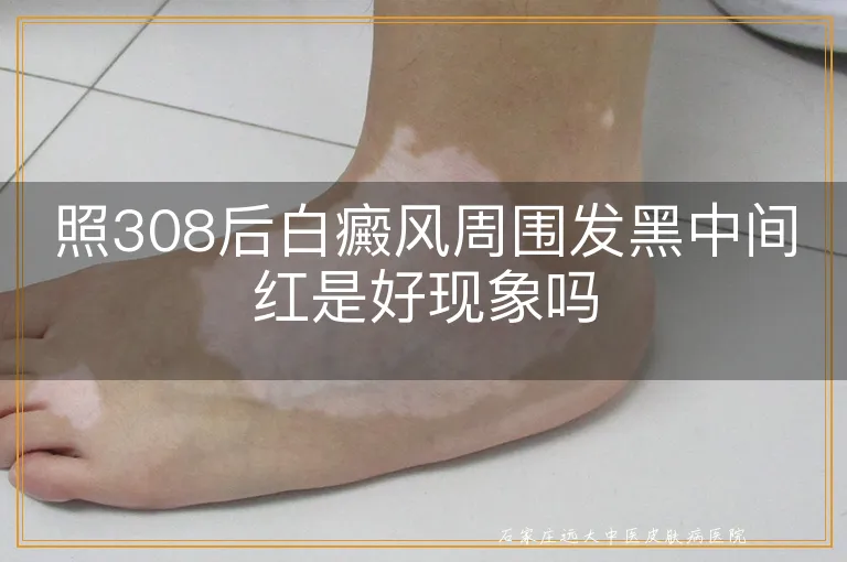 照308后白癜风周围发黑中间红是好现象吗