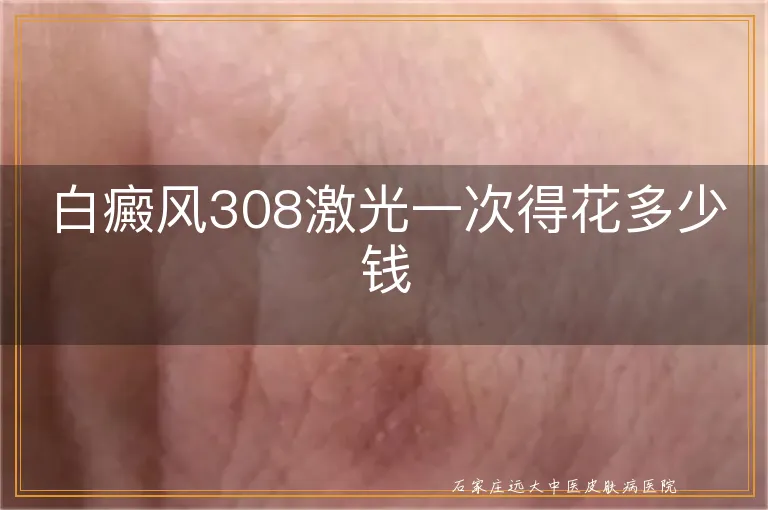 白癜风308激光一次得花多少钱