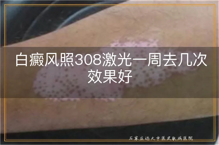 白癜风照308激光一周去几次效果好