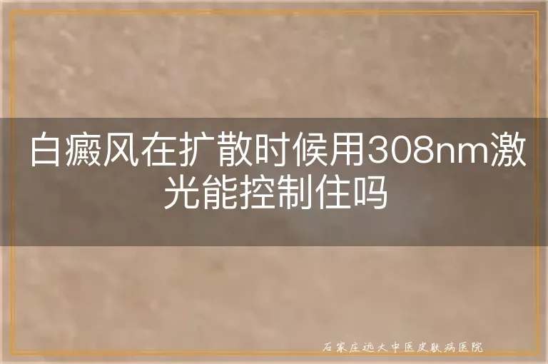 白癜风在扩散时候用308nm激光能控制住吗