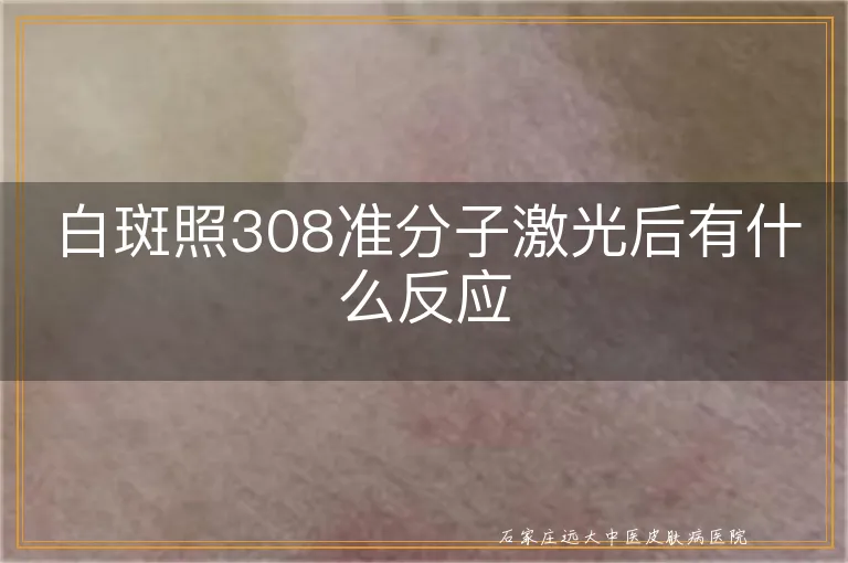 白斑照308准分子激光后有什么反应