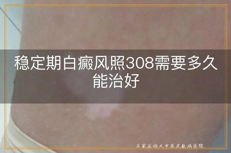 稳定期白癜风照308需要多久能治好