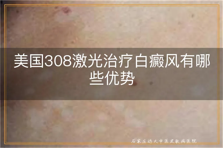 美国308激光治疗白癜风有哪些优势