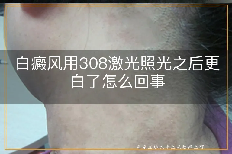 白癜风用308激光照光之后更白了怎么回事