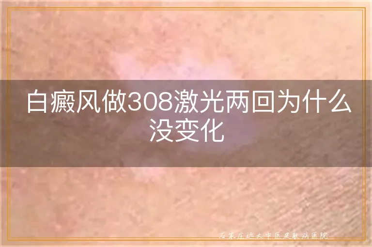 白癜风做308激光两回为什么没变化