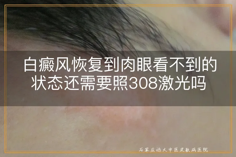 白癜风恢复到肉眼看不到的状态还需要照308激光吗