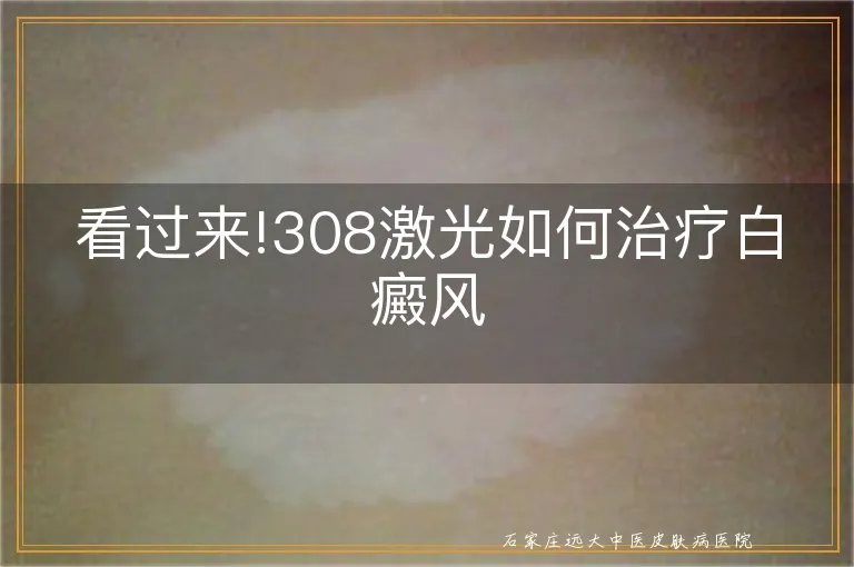 看过来!308激光如何治疗白癜风