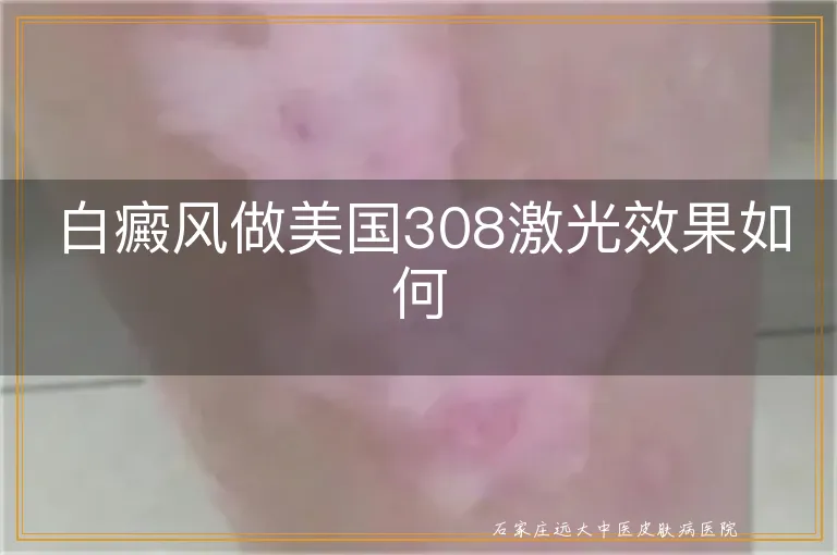 白癜风做美国308激光效果如何