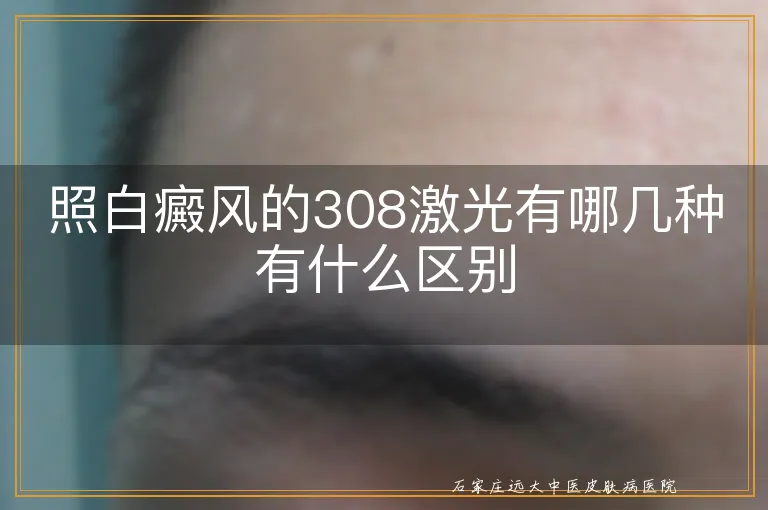 照白癜风的308激光有哪几种有什么区别