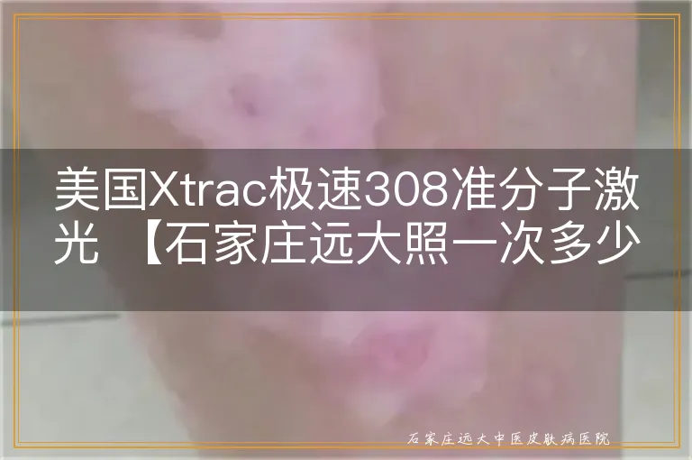 美国Xtrac极速308准分子激光 【石家庄远大照一次多少钱】