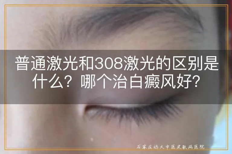 普通激光和308激光的区别是什么？哪个治白癜风好？