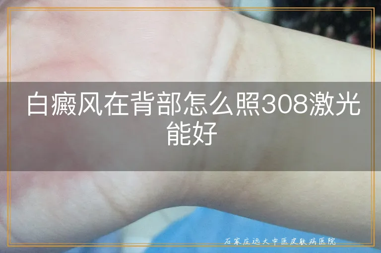 白癜风在背部怎么照308激光能好