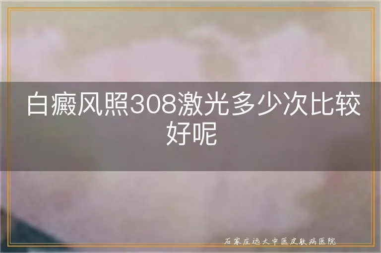 白癜风照308激光多少次比较好呢