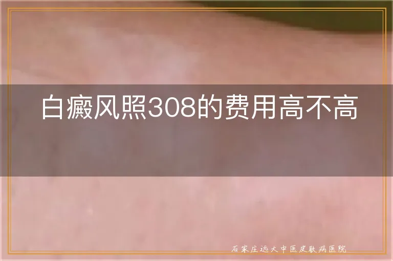 白癜风照308的费用高不高