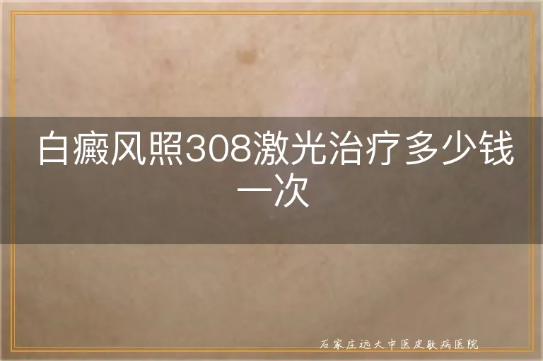 白癜风照308激光治疗多少钱一次