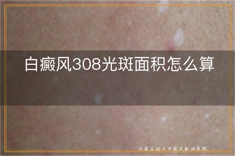 白癜风308光斑面积怎么算