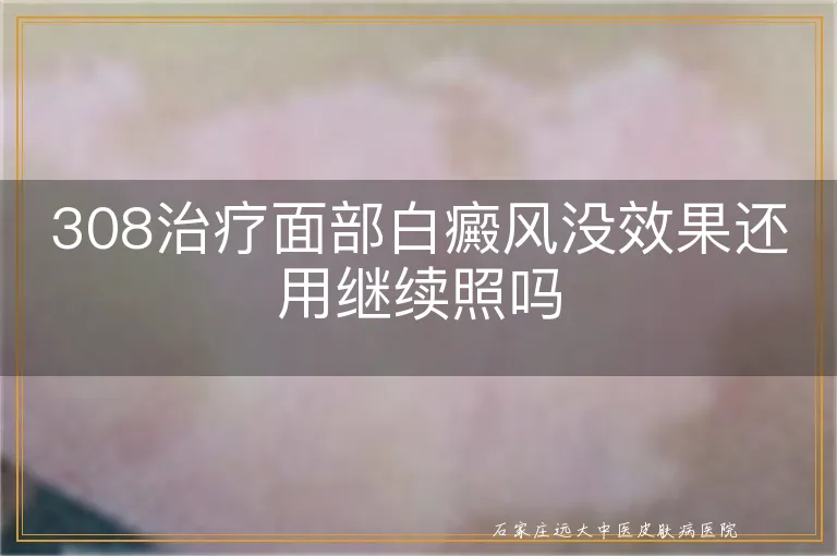 308治疗面部白癜风没效果还用继续照吗