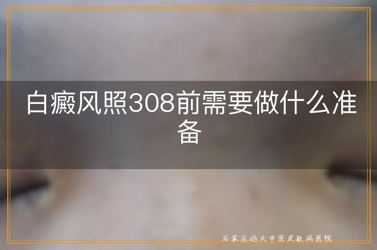 白癜风照308前需要做什么准备