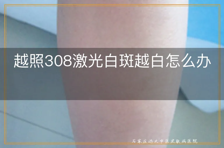 越照308激光白斑越白怎么办