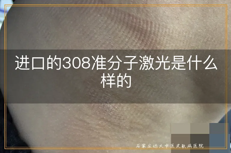 进口的308准分子激光是什么样的