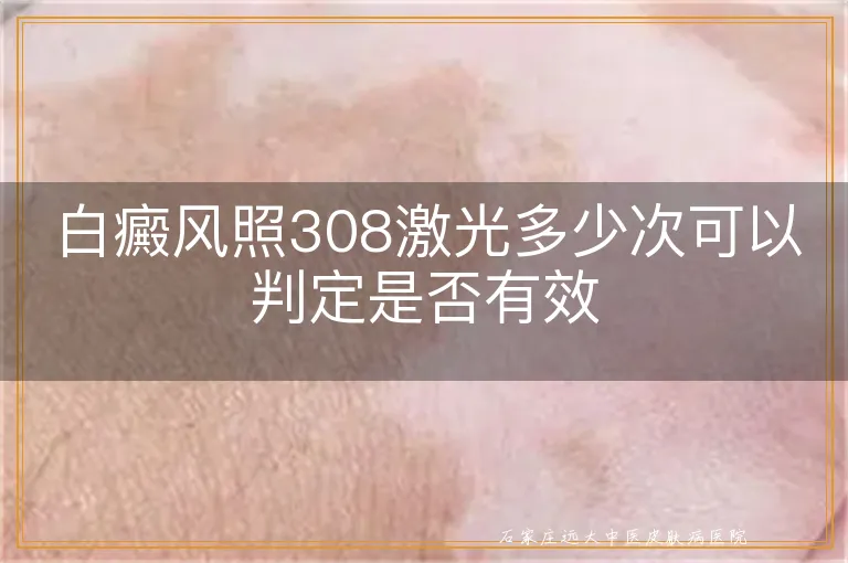 白癜风照308激光多少次可以判定是否有效