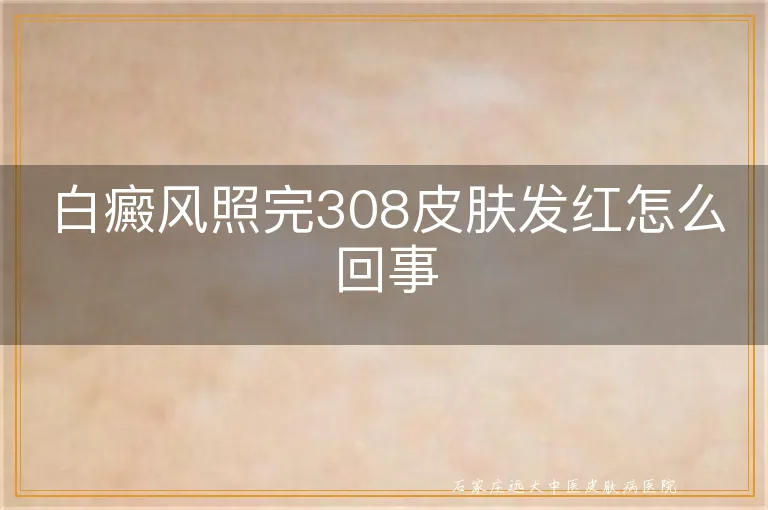 白癜风照完308皮肤发红怎么回事