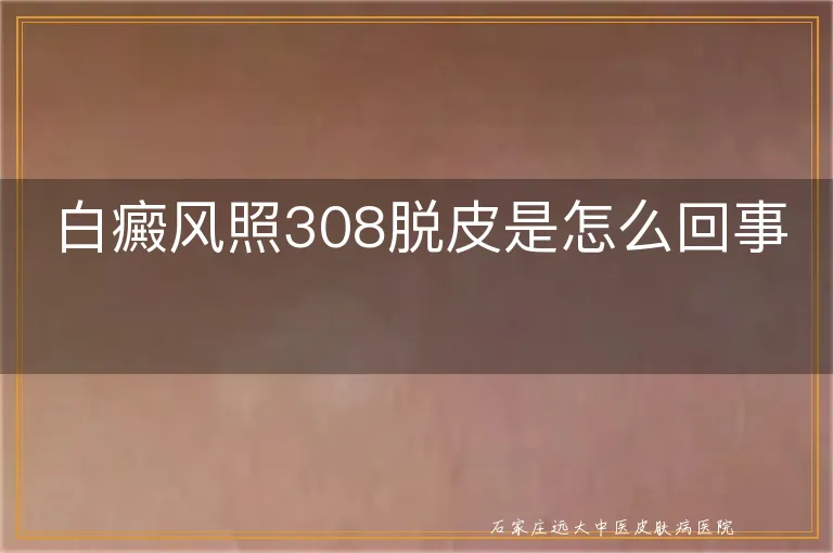 白癜风照308脱皮是怎么回事