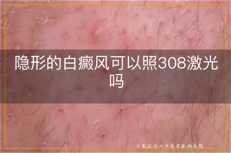 隐形的白癜风可以照308激光吗