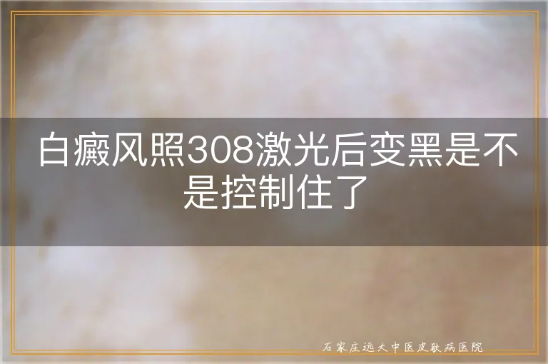 白癜风照308激光后变黑是不是控制住了