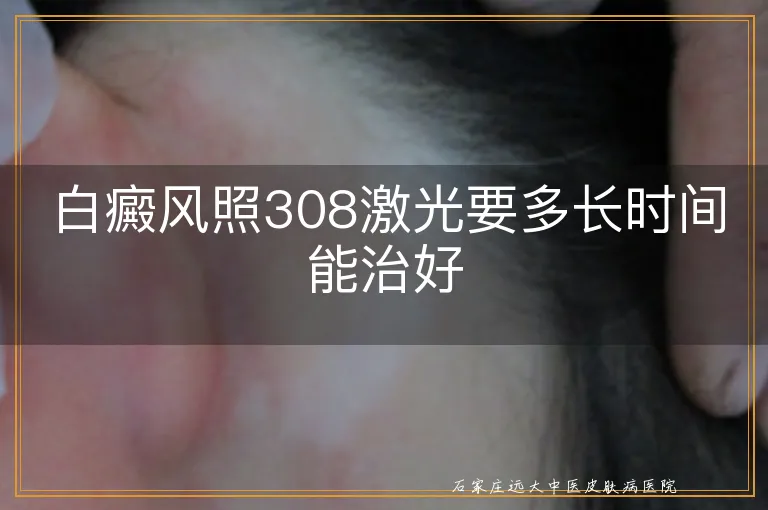 白癜风照308激光要多长时间能治好