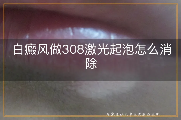 白癜风做308激光起泡怎么消除