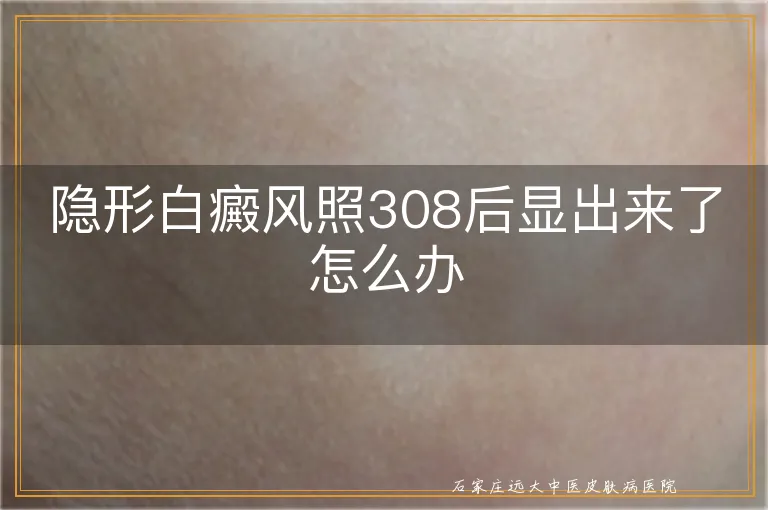 隐形白癜风照308后显出来了怎么办