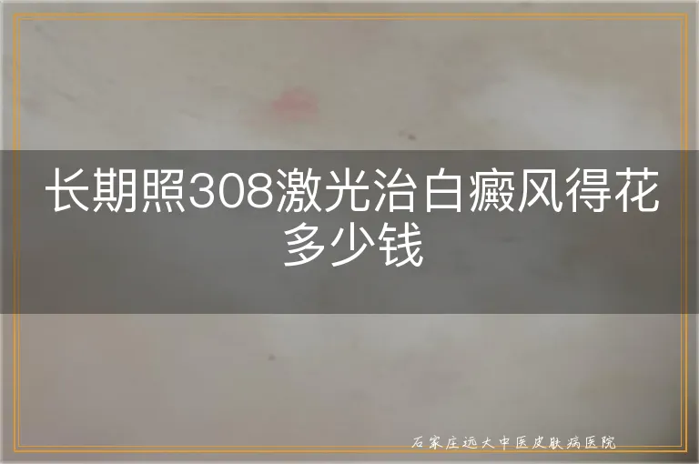 长期照308激光治白癜风得花多少钱