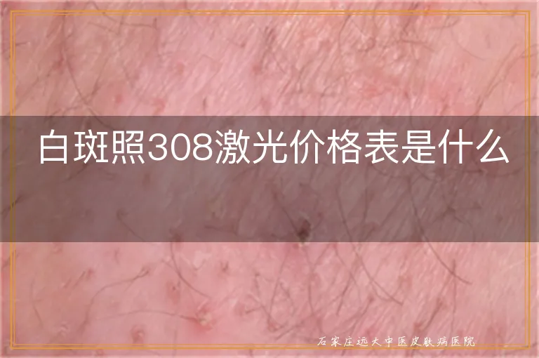 白斑照308激光价格表是什么