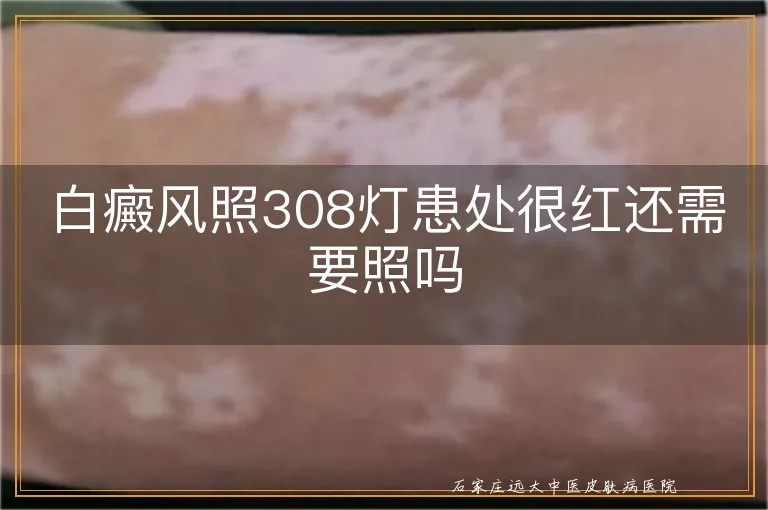 白癜风照308灯患处很红还需要照吗