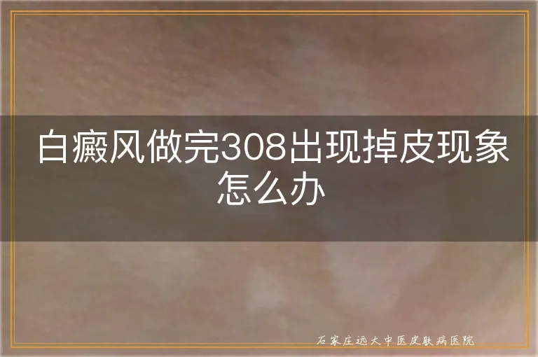 白癜风做完308出现掉皮现象怎么办