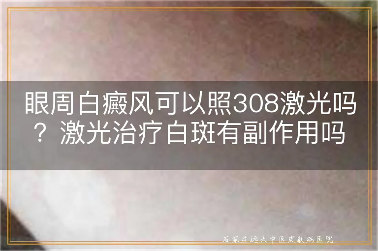 眼周白癜风可以照308激光吗？激光治疗白斑有副作用吗？