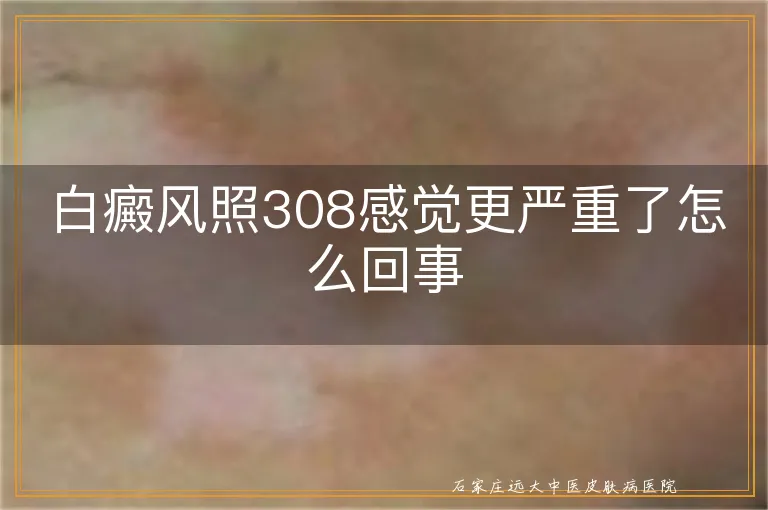 白癜风照308感觉更严重了怎么回事