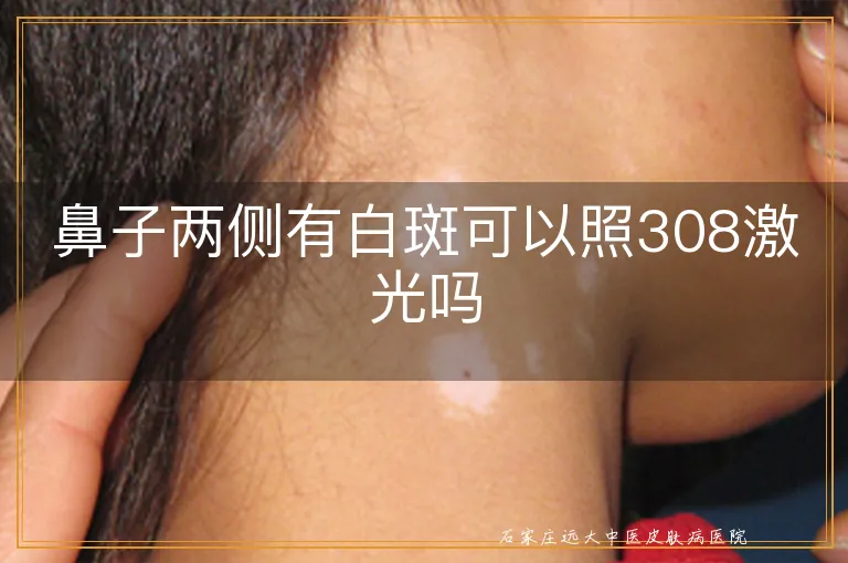 鼻子两侧有白斑可以照308激光吗