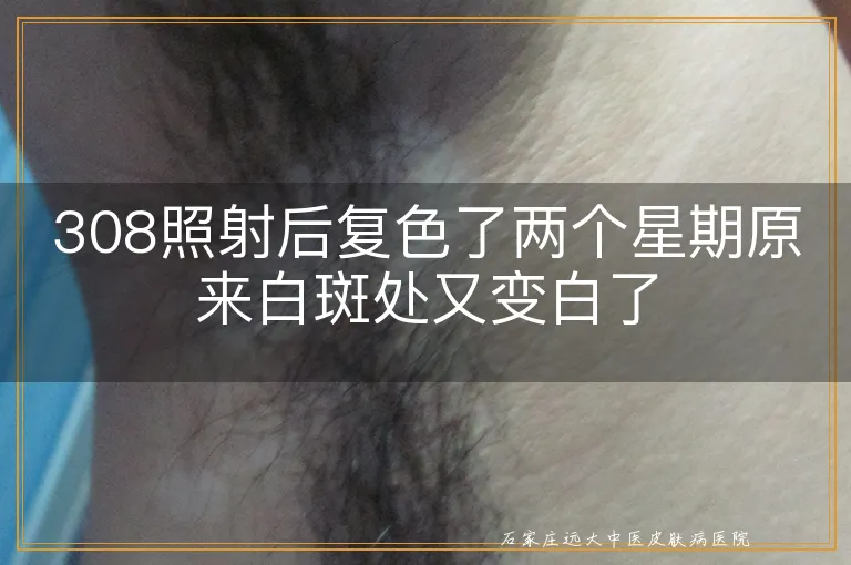 308照射后复色了两个星期原来白斑处又变白了