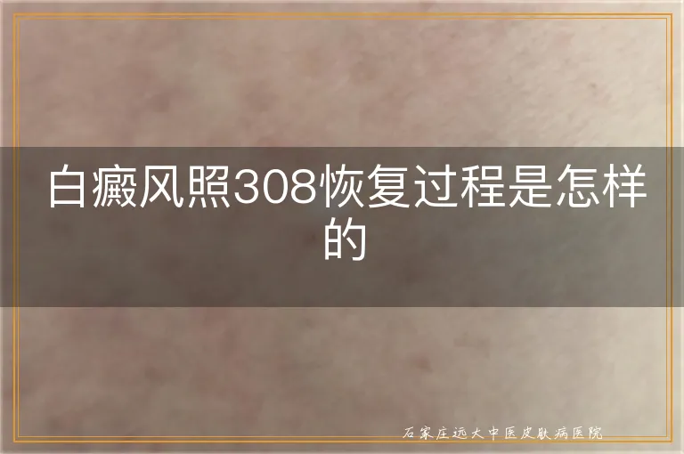 白癜风照308恢复过程是怎样的