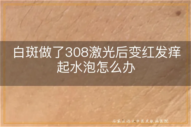 白斑做了308激光后变红发痒起水泡怎么办