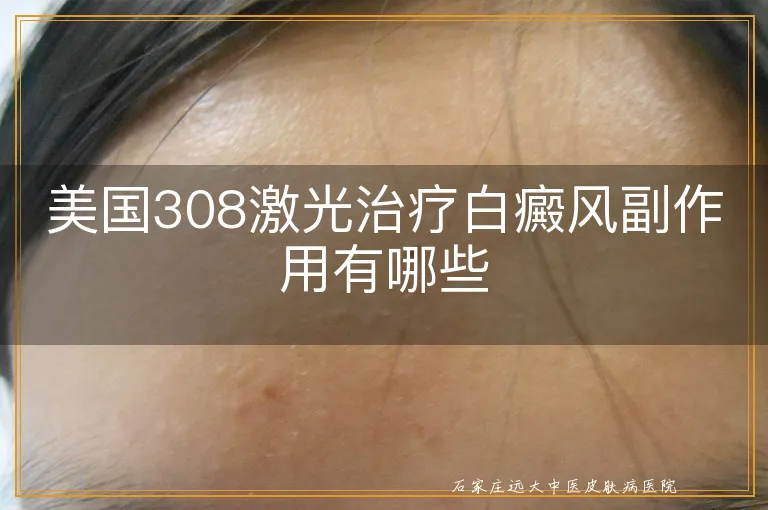 美国308激光治疗白癜风副作用有哪些