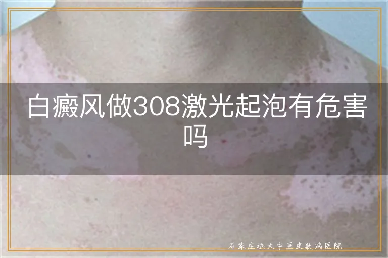 白癜风做308激光起泡有危害吗