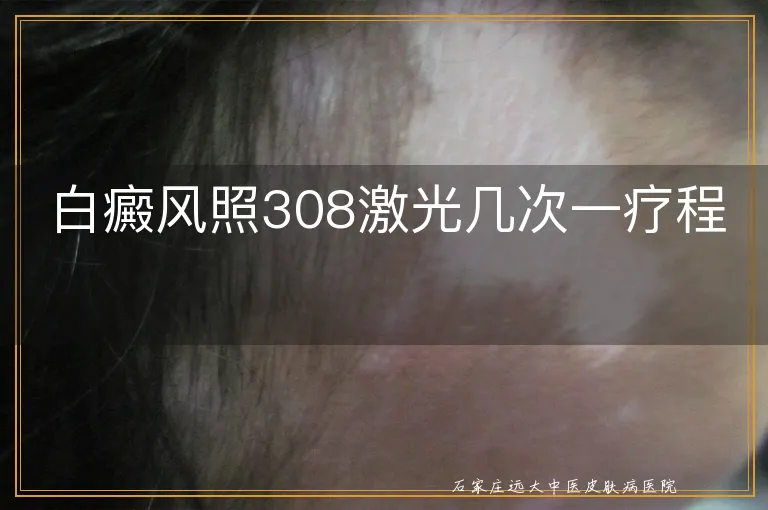 白癜风照308激光几次一疗程