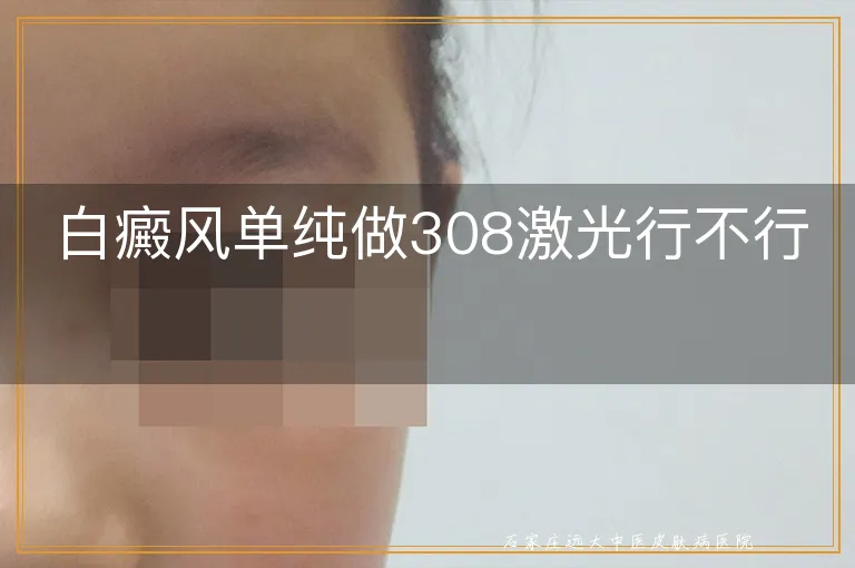 白癜风单纯做308激光行不行