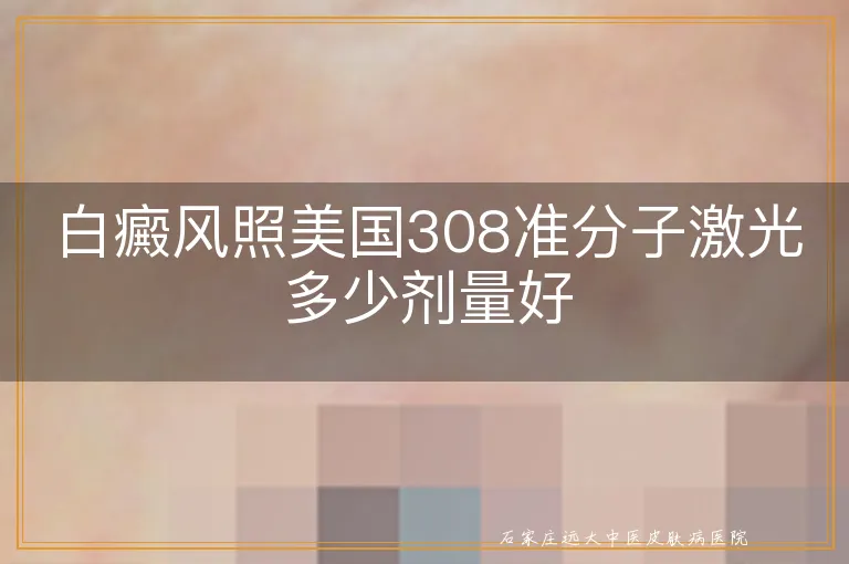 白癜风照美国308准分子激光多少剂量好